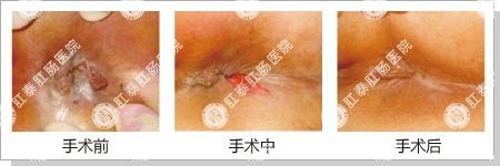 陈旧性肛裂手术图