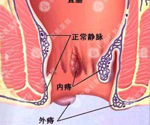 痔疮的症状
