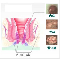 福州痔疮初期有什么症状？