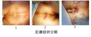 福州痔疮肛瘘治疗
