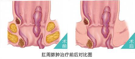 福州痔疮有个硬的肿块是什么东西？