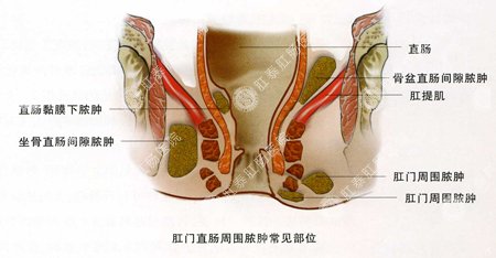 福州屁股肿了用什么药好得快？